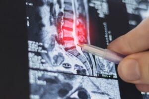 Can You Get a Herniated Disc From a Minor Car Accident?