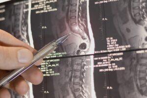 How Much Is a Herniated Disc Case Worth in Florida?